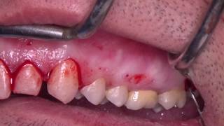 Gummy Smile Correction Surgery Dr Elie Maalouf [upl. by Nahum]