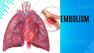 EMBOLISMTYPES AND HISTOPATHOLOGY FATEMBOLISM AIREMOLISM AMNIOTIFLUIDEMBOLISM PULMONARYEMBOLISM [upl. by Ahsener]