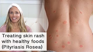 Treating skin rash and inflammation with healthy foods Pityriasis Rosea [upl. by Noraf]