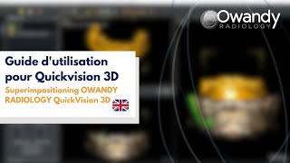 5 SuperimpositioningOWANDY RADIOLOGYQuickVision 3D [upl. by Jp]