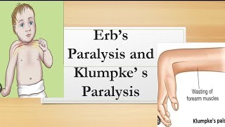 Erbs Palsy and Klumpke s Palsy  Upper Limb in 7 Days  Brachial Plexus Anatomy  Horner Syndrome [upl. by Navets551]