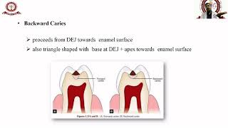 Dental Caries Classification [upl. by Olimpia151]