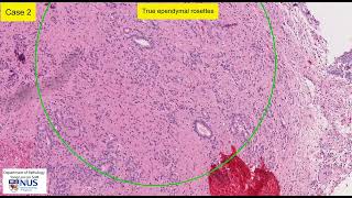 Ependymoma microscopy  Talking slide [upl. by Rorry]