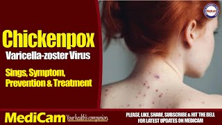 Chickenpox Signs Symptoms Prevention And Treatment [upl. by Nwahsan]