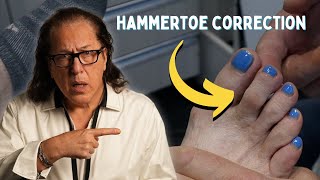 Hammertoe Correction Without Invasive Surgery [upl. by Cormick472]