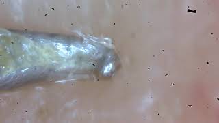 Demodex Facemite removal [upl. by Armahs]