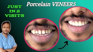 Tooth gap closed by Emax Veneers  emax veneers porcelainveneers [upl. by Reeves57]