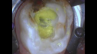 FNPD Techniques  LSTR Lesion Sterilization and Tissue Repair Primary Teeth [upl. by Bonnee]