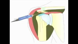 Acromioplastie arthroscopique de lépaule pour tendinite [upl. by Hill]