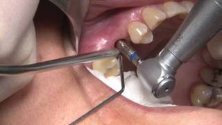 Dental Implant Laser Surgery with the CO2 Laser [upl. by Wickham855]