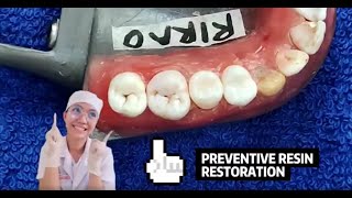 PEDO Preventive Resin Restoration [upl. by Ppik]