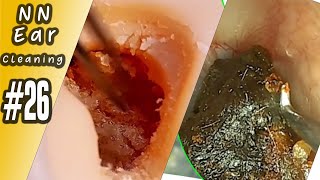 Impacted Ear Wax RemovalEP26  NN Ear cleaning [upl. by Aramoix394]