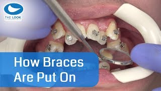 How braces are put on  AMAZING   Now with 12 month  Progress  httpsgoogljXaY15 [upl. by Dareen142]