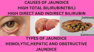 CAUSES OF JAUNDICECAUSES OF HIGH TOTAL BILIRUBINWHY IS MY DIRECT AND INDIRECT BILIRUBIN HIGH [upl. by Ahsikahs]