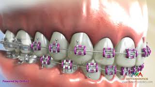 Orthodontic Braces  Different Parts 2 [upl. by Nyasuh431]