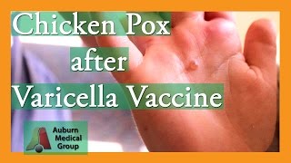 Chicken Pox after Varicella Vaccine  Auburn Medical Group [upl. by Khajeh]