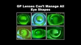 Build Your Practice with Specialty RGP Lenses [upl. by Aranaj]