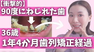 【歯列矯正】36歳1年4か月経過報告【歯列矯正経過】アラフォー【表側ワイヤー矯正】捻転歯｜八重歯【braces】 [upl. by Teodorico]