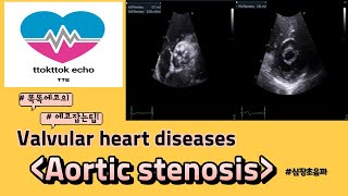 Aortic stenosis AS aortic valve 대동맥판막 협착증 echocardiography 심장초음파 heart echo view [upl. by Keir]