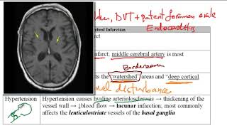 USMLE ACE Video 208 Comprehensive Guide to Ischemic Brain Stroke [upl. by Nyvets]