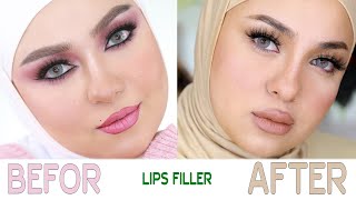 Before and after filler lips [upl. by Imelida]