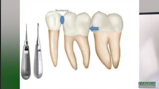 How to make molar extractions easier [upl. by Tecu136]