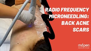 RF Microneedling Back Acne Scars Treatment [upl. by Clio857]