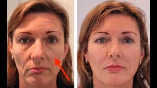 How Cheek Filler unlocks the mid face in minutes [upl. by Donica78]