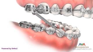 Orthodontic Treatment for Overjet Overbite  Forsus Appliance [upl. by Consolata]