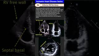 Ischemic Heart Disease 5 Inferior MI [upl. by Paten777]