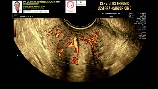 Cervicitis chronic  Lesi Pracancer  CIN 3 [upl. by Frierson]