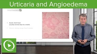 Urticaria Hives and Angioedema – Pediatrics  Lecturio [upl. by Nagy373]