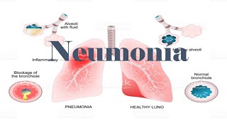 NEUMONÍA RADIOGRAFÍA FISIOPATOLOGÍA ETIOLOGÍA CLASIFICACIÓN [upl. by Fabien767]