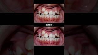 20 months Braces Transformation braces dentist orthodontist dental [upl. by Poulter]