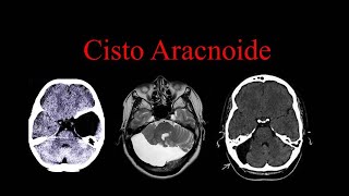 Cisto Aracnoide  Malformações Congênitas NEURORADIOLOGIA [upl. by Hescock]