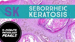 Seborrheic Keratosis 5Minute Pathology Pearls [upl. by Yttap]