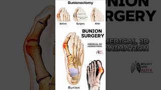 Bunion Surgery medical animation 3d short BiologywithAliya [upl. by Browne]