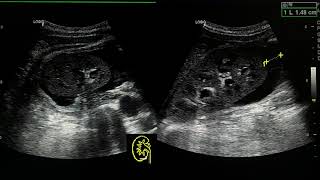 acute pyelonephritis ultrasound case [upl. by Aluino]