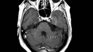 HSV Encephalitis [upl. by Reivazx]