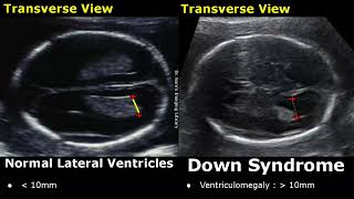 Fetal Ultrasound Normal Vs Down Syndrome  Soft Markers In Fetus For Trisomy 21  Aneuploidies USG [upl. by Adehsar]