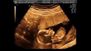 EMBARAZO 14 SEMANAS  ECOGRAFIA 3D y 4D de nuestro peke  ULTRASOUND 14 WEEKS SUANSI [upl. by Tacye]