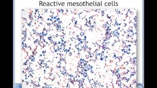 Prof JFのレクチャー Pathology of mesothelial cells [upl. by Edita]