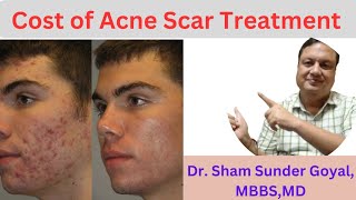 Cost Of Acne Scar Treatment  Cost of Combination Treatment  Acne Scar [upl. by Zaria]