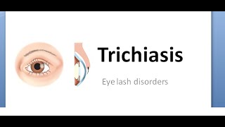 Ophthalmology 379 Trichiasis Eye lash rubbing eye inward eyelash PseudoTrichiasis DisTiChiasis [upl. by Eissoj]