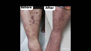 STOP SKIN PROBLEMS WITH HOMOEOPATHY [upl. by Llerryt310]