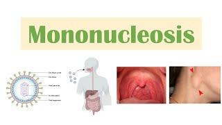 Infectious Mononucleosis Mono  EpsteinBarr Virus Transmission Symptoms Diagnosis Treatment [upl. by Enenstein]