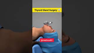 Thyroid gland surgery in 3d shorttrendingshorts thyroid surgeryreview viralshort [upl. by Thgiwd854]