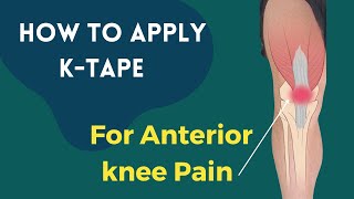 How to treat Knee Pain Patellofemoral Pain syndrome using Kinesiology tape [upl. by Branen]