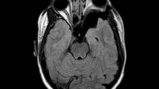 Sphenoid Wing Dysplasia [upl. by Weikert]