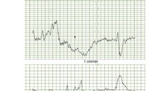 Decelerations Prolonged [upl. by Maryrose]